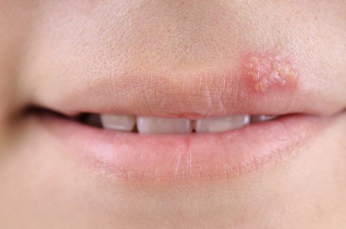 How to get rid of a cold sore?